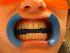 Auftragen des Zahnfleischschutzes